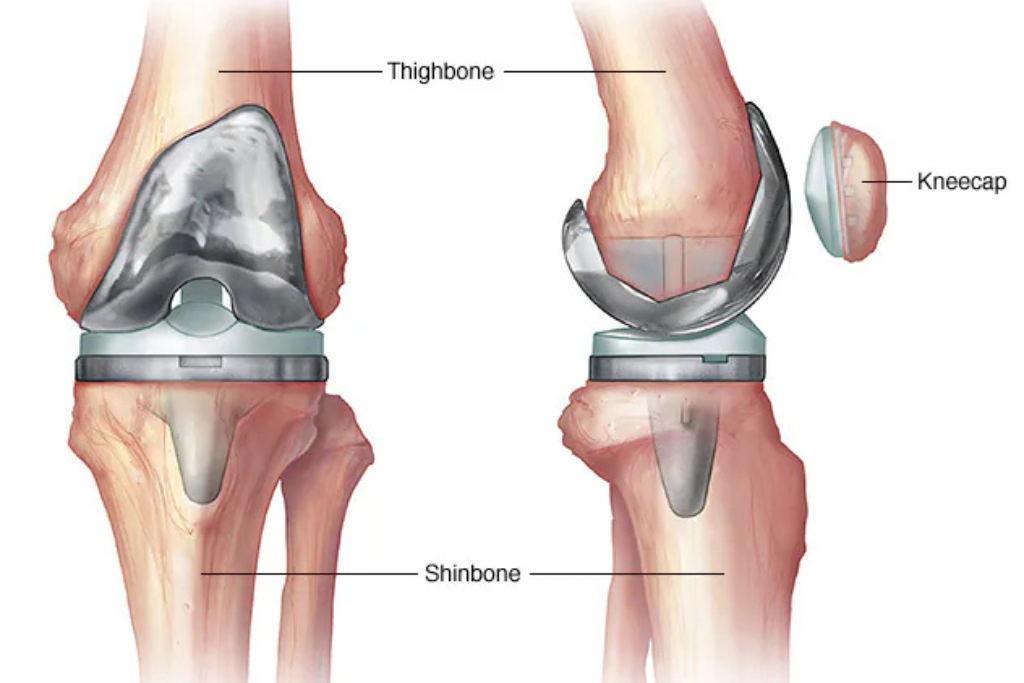 Knee Replacement Surgery: Cost, Recovery, Risks & Benefits Guide